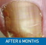 6 months after treatment