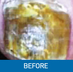 before laser treatment