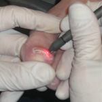 close up of laser nail treatment