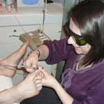 lasing the toe nail