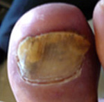 an example of nail fungus
