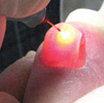 pinpointe laser being use on a toe nail