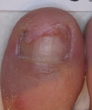 After Laser Nail Treatment