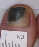 Before Laser Nail Treatment