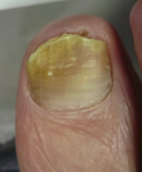After Laser Nail Treatment