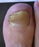 Before Laser Nail Treatment