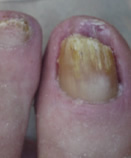 After Laser Nail Treatment