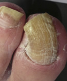 Before Laser Nail Treatment
