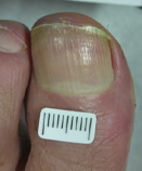 After Laser Nail Treatment