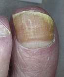 Before Laser Nail Treatment