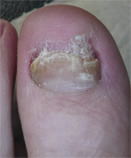 After Laser Nail Treatment