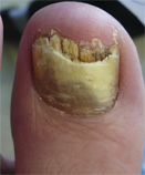 Before Laser Nail Treatment