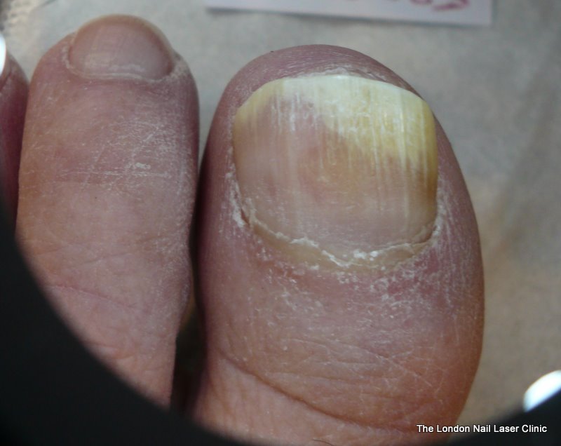 Before Laser Nail Treatment