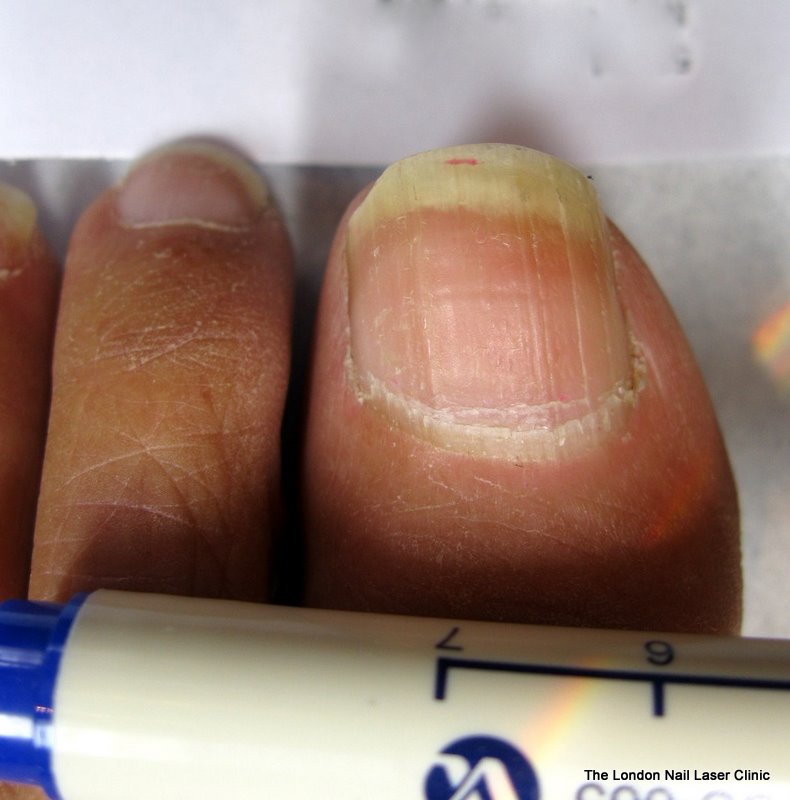 After Laser Nail Treatment