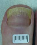 After Laser Nail Treatment