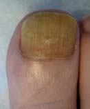 Before Laser Nail Treatment
