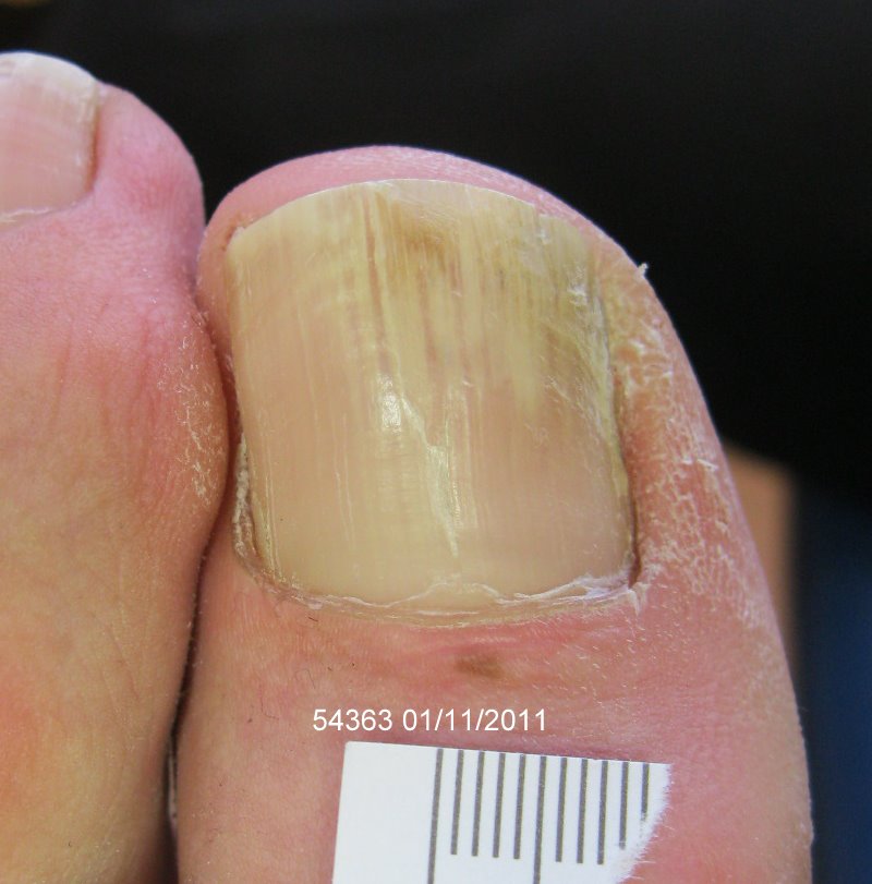 After Laser Nail Treatment