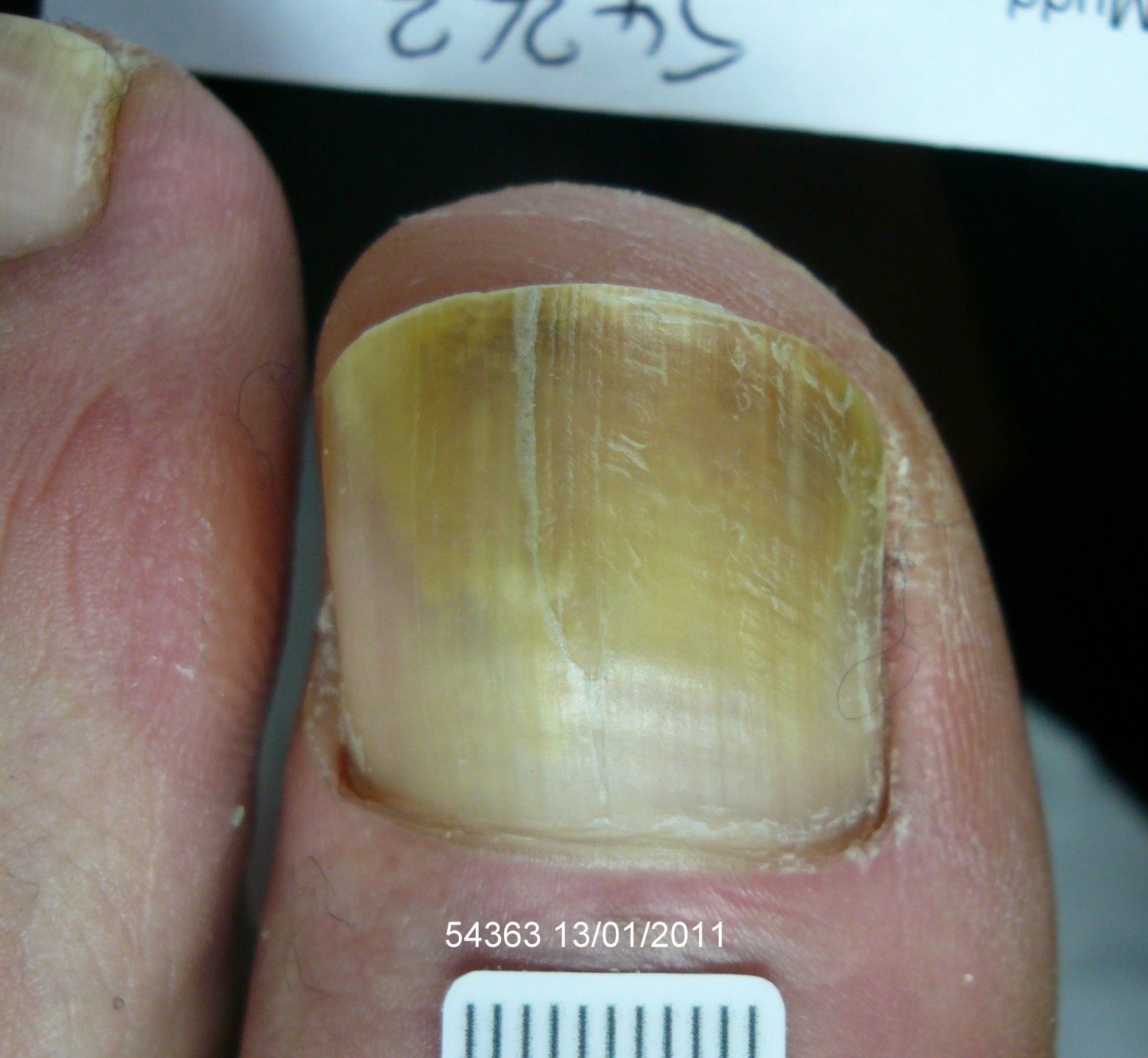 Before Laser Nail Treatment