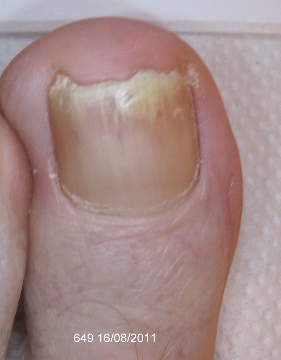 After Laser Nail Treatment