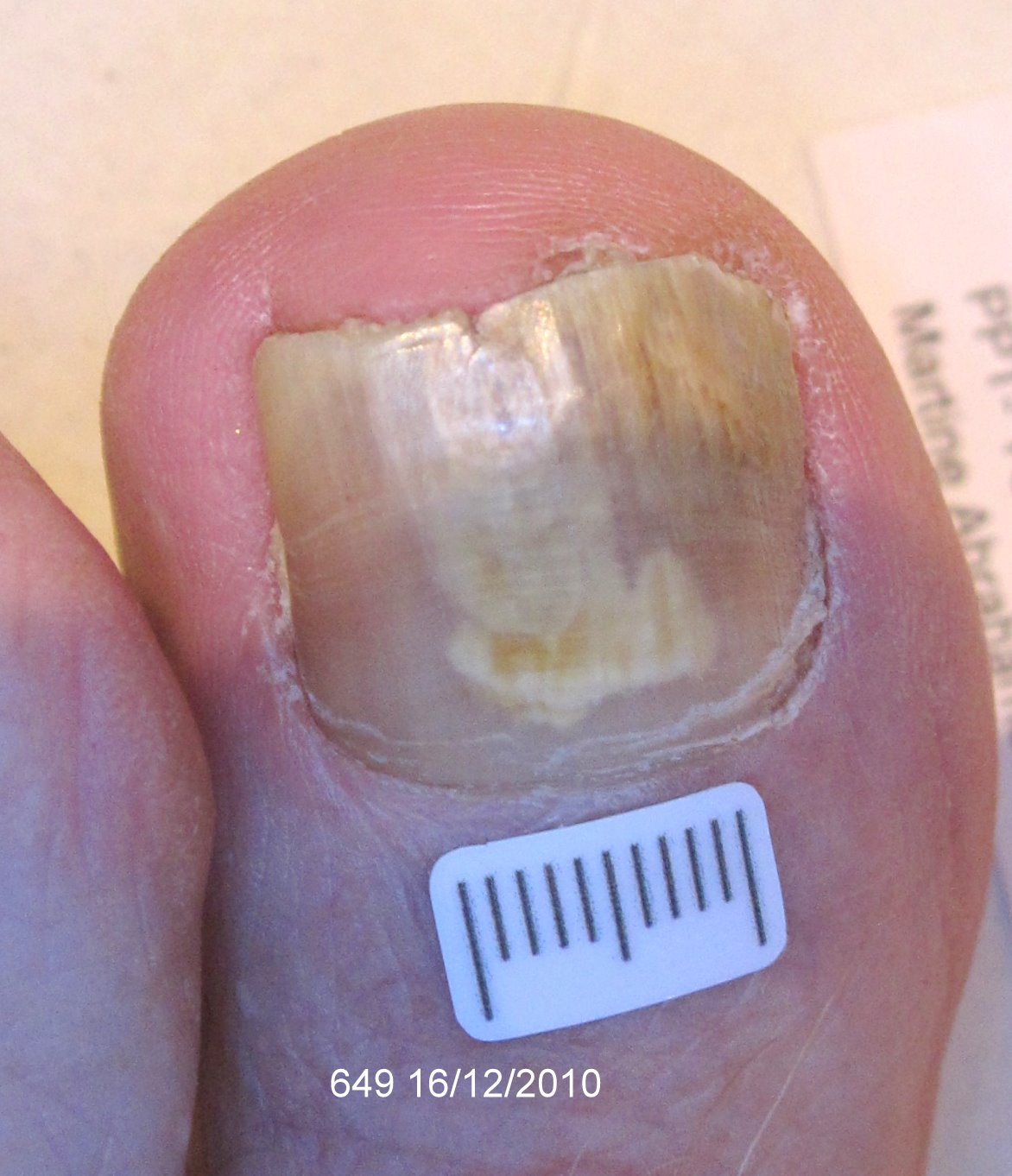 Before Laser Nail Treatment