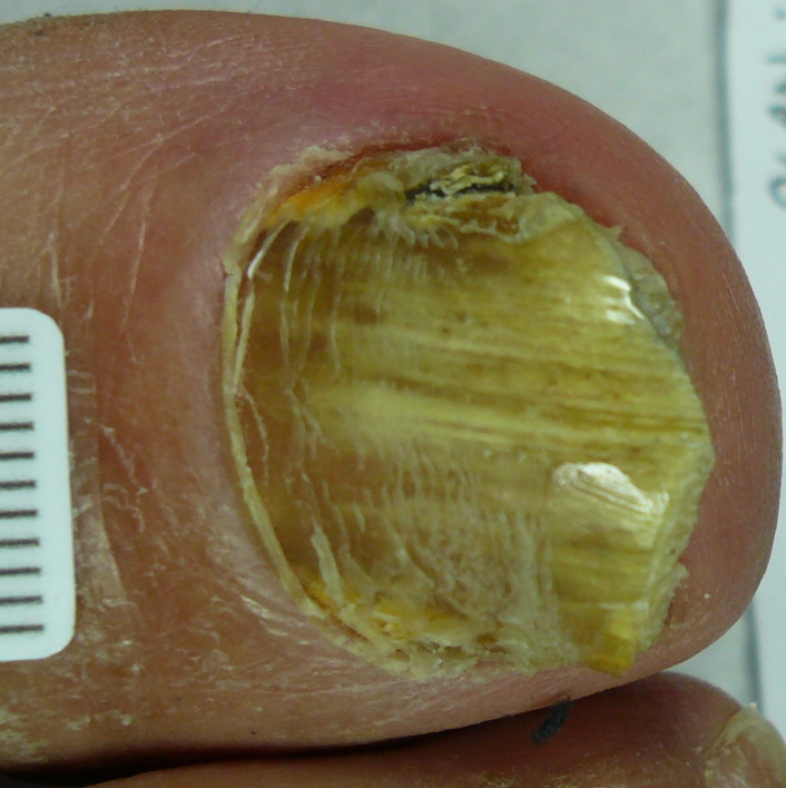 Before Laser Nail Treatment