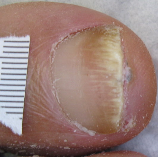 After Laser Nail Treatment