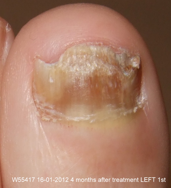 After Laser Nail Treatment