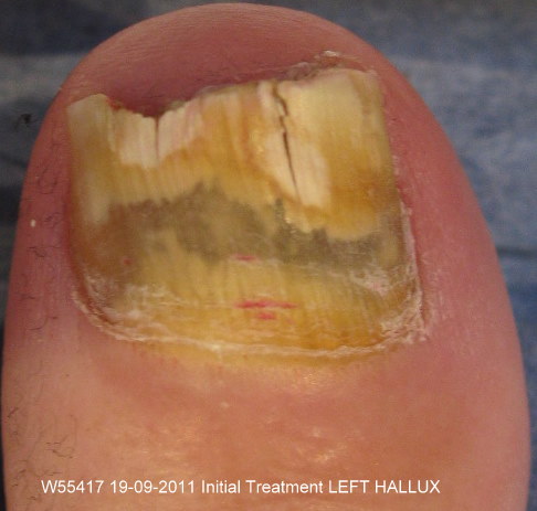 Before Laser Nail Treatment